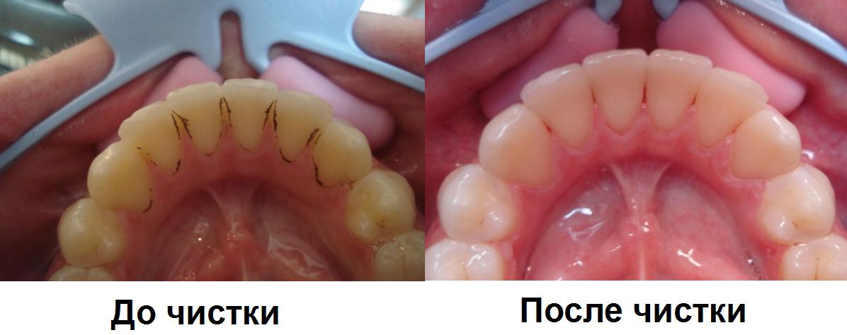 профессиональная чистка зубов