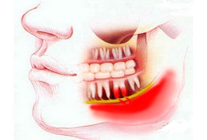 Флегмона зуба